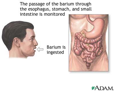 Barium ingestion Barium ingestion