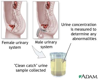 Urine concentration test Urine concentration test