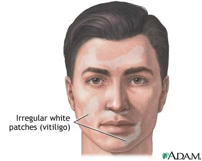Vitiligo Vitiligo