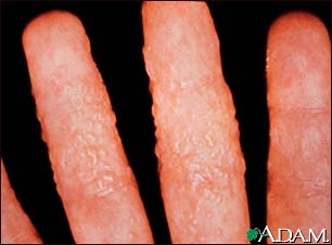 Dermatitis, reaction to tinea Dermatitis, reaction to tinea
