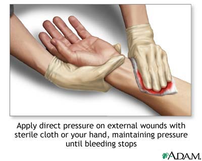 Stopping bleeding with direct pressure Stopping bleeding with direct pressure