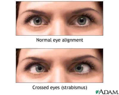 Crossed eyes Crossed eyes
