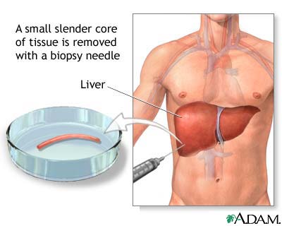 Liver biopsy Liver biopsy