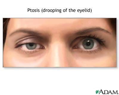 Ptosis, drooping of the eyelid Ptosis, drooping of the eyelid