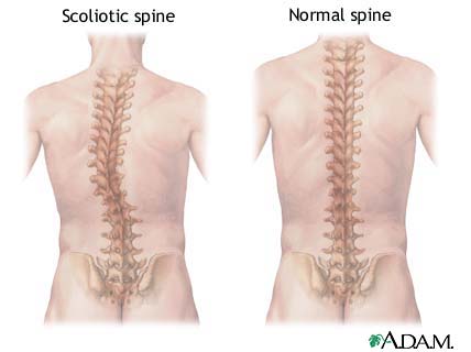 Scoliosis Scoliosis