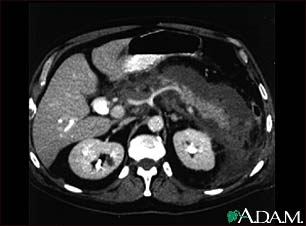 Pancreatitis, acute - CT scan Pancreatitis, acute - CT scan