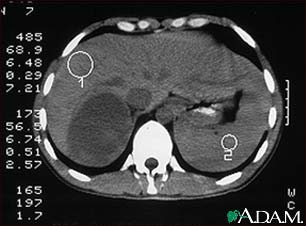 Adrenal Tumor - CT Adrenal Tumor - CT