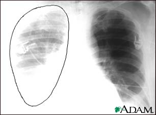 Aortic rupture, chest X-ray Aortic rupture, chest X-ray