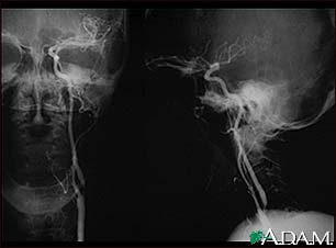 Carotid stenosis, X-ray of the left artery Carotid stenosis, X-ray of the left artery