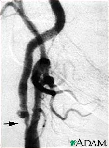 Carotid stenosis, X-ray of the right artery Carotid stenosis, X-ray of the right artery