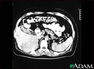 Cholecystitis, CT scan Cholecystitis, CT scan