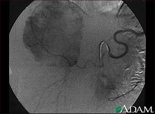 Hemangioma - angiogram Hemangioma - angiogram