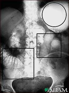 Ileus - X-ray of distended bowel and stomach Ileus - X-ray of distended bowel and stomach
