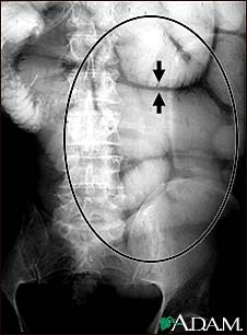 Ileus - X-ray of bowel distension Ileus - X-ray of bowel distension