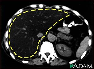 Liver fattening, CT scan Liver fattening, CT scan