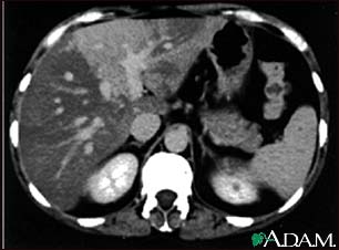 Liver with disproportional fattening, CT scan Liver with disproportional fattening, CT scan