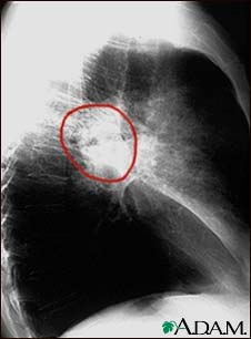 Lung cancer, lateral chest X-ray Lung cancer, lateral chest X-ray