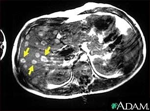 Melanoma of the liver - MRI scan Melanoma of the liver - MRI scan