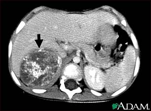Neuroblastoma in the liver - CT scan Neuroblastoma in the liver - CT scan