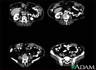 Peritoneal and ovarian cancer, CT scan Peritoneal and ovarian cancer, CT scan