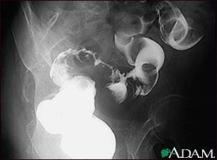 Sigmoid colon cancer, X-ray Sigmoid colon cancer, X-ray