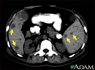 Spleen metastasis - CT scan Spleen metastasis - CT scan