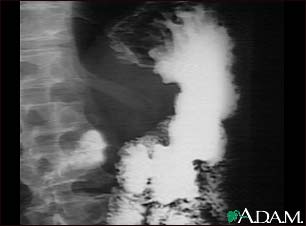 Stomach cancer, X-ray Stomach cancer, X-ray