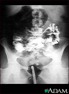 Volvulus - X-ray Volvulus - X-ray