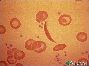 Red blood cells, sickle cell Red blood cells, sickle cell