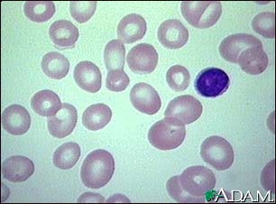 Megaloblastic anemia - view of red blood cells Megaloblastic anemia - view of red blood cells