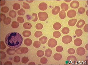 Red blood cells, spherocytosis Red blood cells, spherocytosis