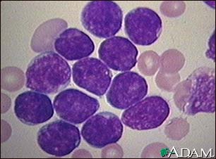 Acute lymphocytic leukemia - photomicrograph Acute lymphocytic leukemia - photomicrograph