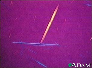Uric acid crystals Uric acid crystals