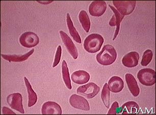 Red blood cells, multiple sickle cells Red blood cells, multiple sickle cells