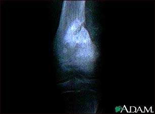 Osteogenic sarcoma - X-ray Osteogenic sarcoma - X-ray