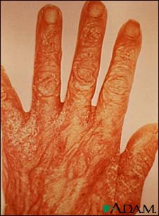 Scabies rash and excoriation on the hand Scabies rash and excoriation on the hand