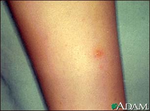 Chickenpox - lesion on the leg Chickenpox - lesion on the leg