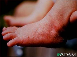 Erythema toxicum on the foot Erythema toxicum on the foot