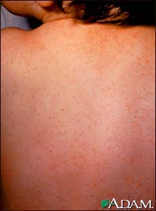 ECHO virus type 9 exanthem ECHO virus type 9 exanthem