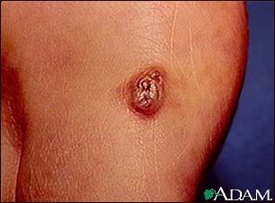 Kaposi's sarcoma - lesion on the foot Kaposi's sarcoma - lesion on the foot