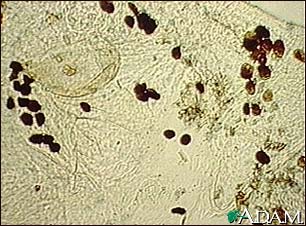 Scabies mite, photomicrograph of the stool Scabies mite, photomicrograph of the stool
