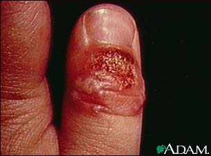 Herpetic whitlow on the thumb Herpetic whitlow on the thumb