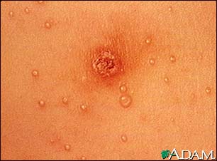 Molluscum contagiosum - close-up of the chest Molluscum contagiosum - close-up of the chest