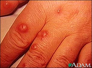 Cryptococcus, cutaneous on the hand Cryptococcus, cutaneous on the hand