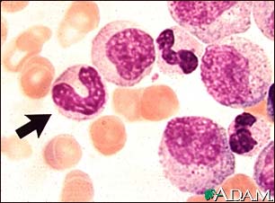 Chronic myelocytic leukemia - microscopic view Chronic myelocytic leukemia - microscopic view