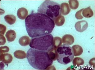 Chronic myelocytic leukemia Chronic myelocytic leukemia