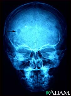 Eosinophilic granuloma - X-ray of the skull Eosinophilic granuloma - X-ray of the skull