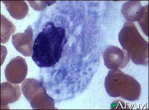 Gaucher cell, photomicrograph #2 Gaucher cell, photomicrograph #2