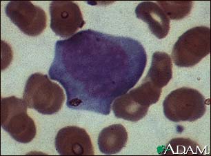 Mononucleosis, photomicrograph of cells Mononucleosis, photomicrograph of cells