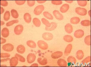 Ovalocytoses Ovalocytoses